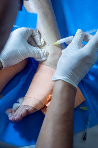 Escleroterapia: El tratamiento estrella para despedirte de las «arañitas»