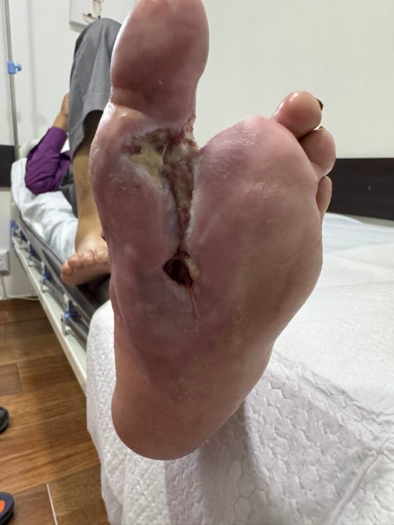 Úlceras por pie diabético: Caso clínico exitoso